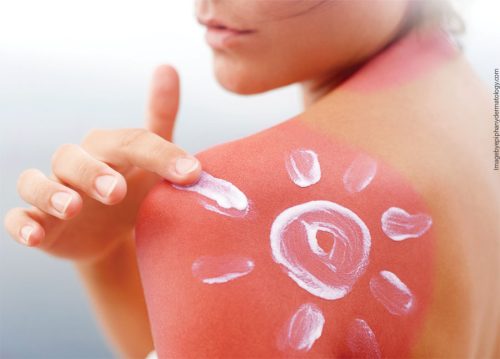 Como tratar las quemaduras de sol