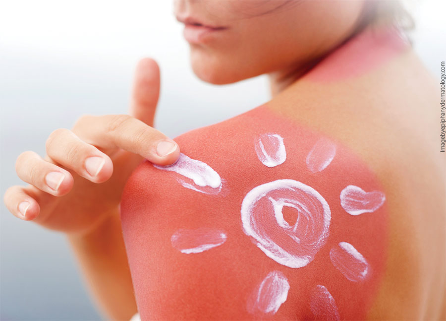 Como tratar las quemaduras de sol