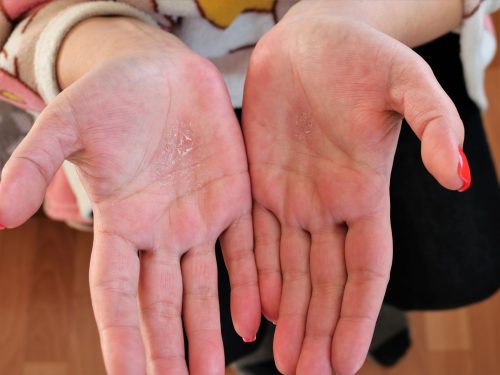dermatitis de contacto