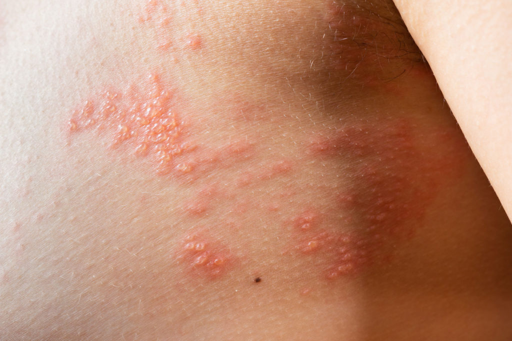 dermatitis