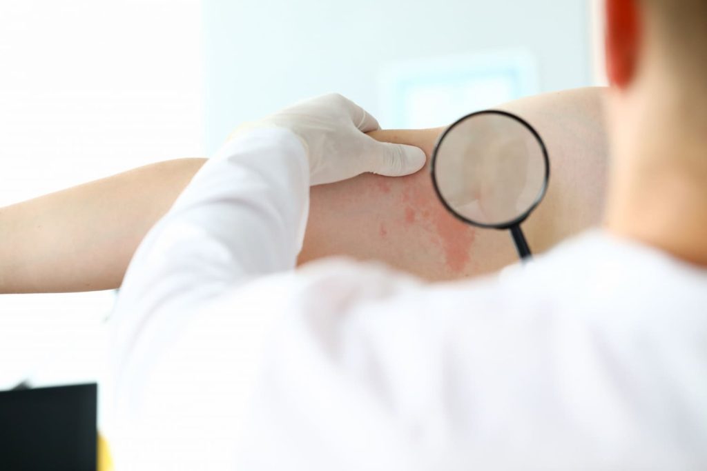 síntomas de la dermatitis